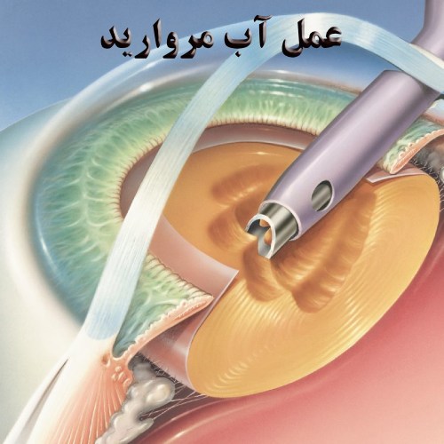 عمل آب مروارید
