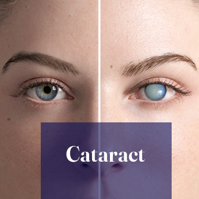 Cataract Surgery
