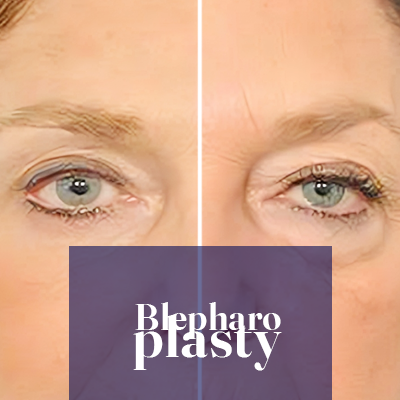 Blepharoplasty